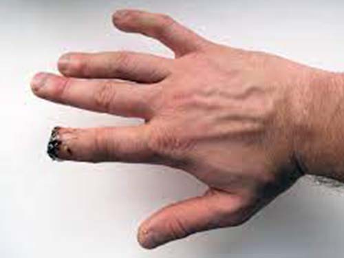 Finger tip amputation Kenya