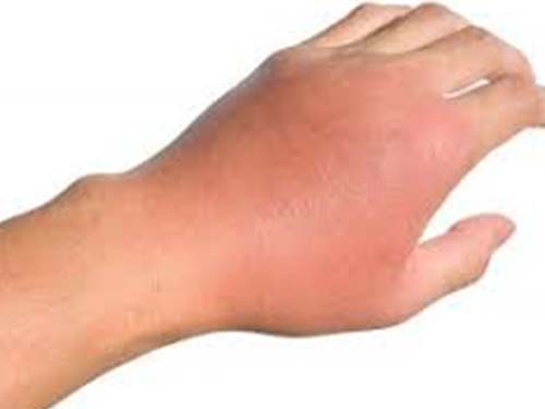 Hand infection Kenya