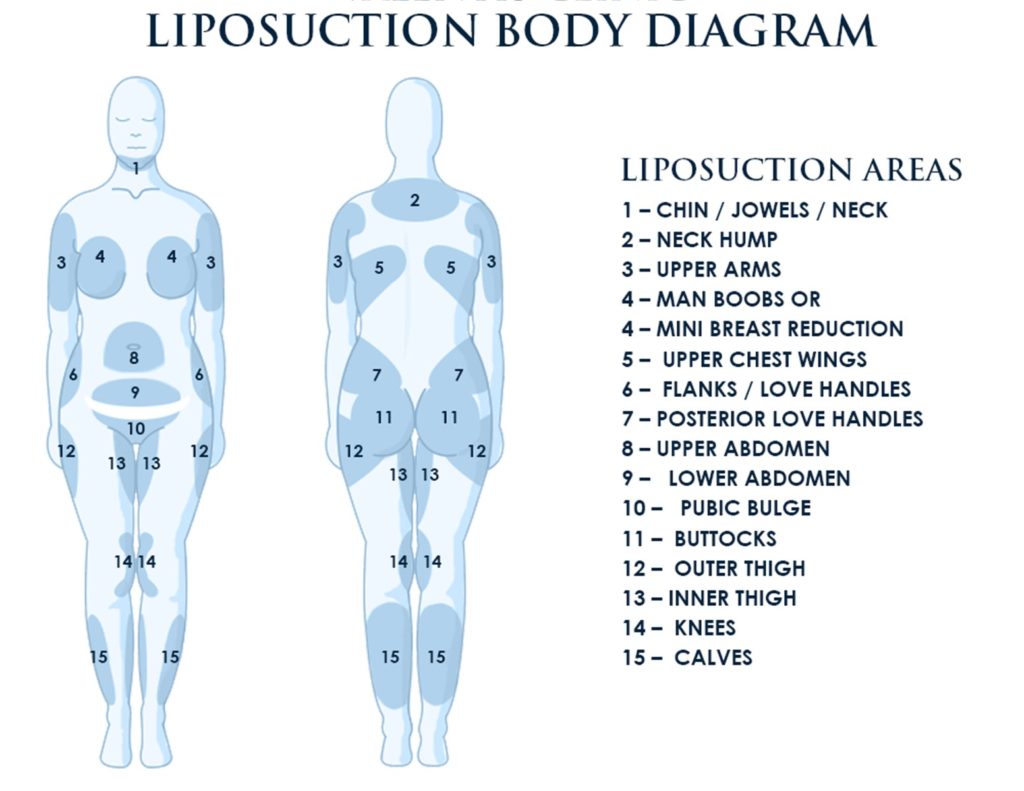 Liposuction Body areas Diagram