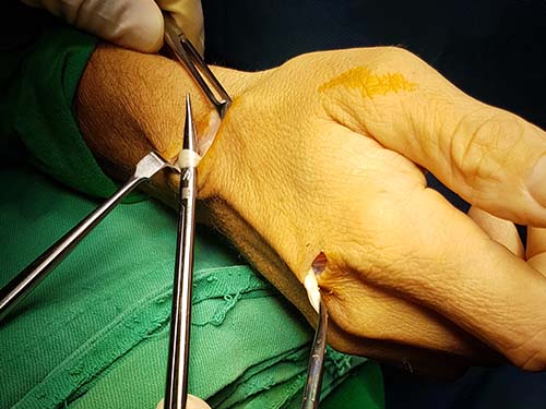 Tendon Surgery Kenya