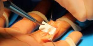 Hand nerve reconstruction Kenya