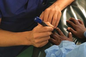 Syndactyly op by Dr Stasch Kenya