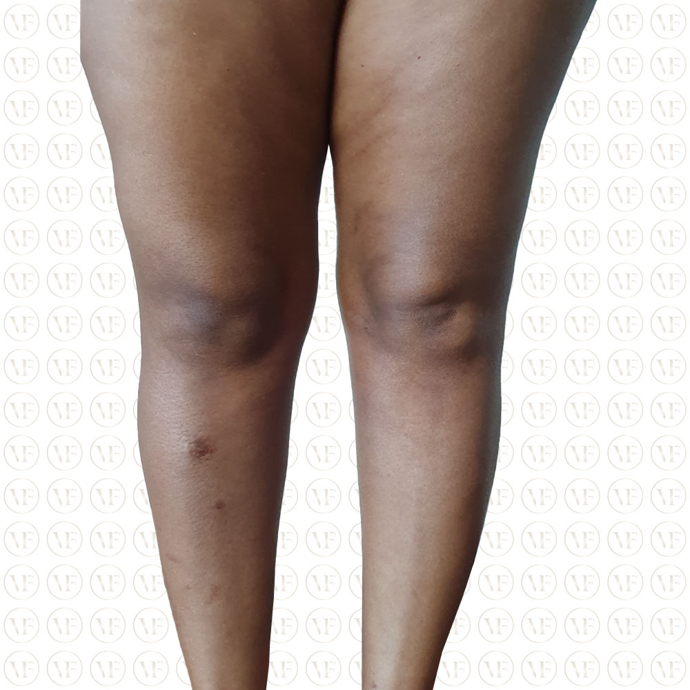 Fatgrafting legs - Vitality Fountain Clinic