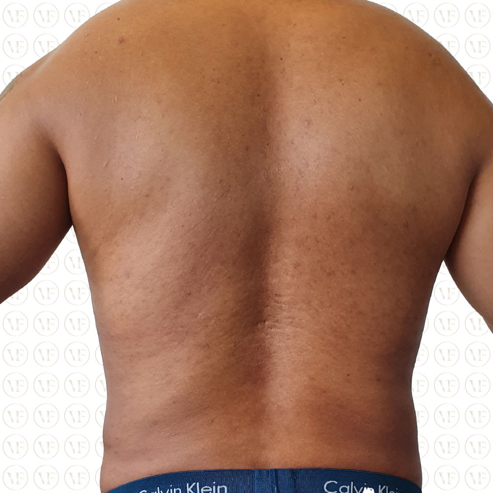 Liposutction-Six-pack-Male - Vitality Fountain Clinic