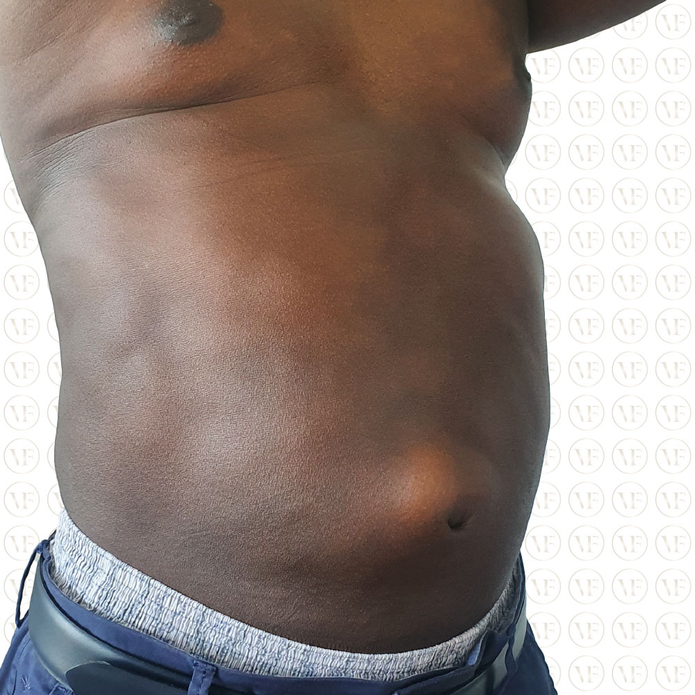 Liposutction 360 Male - Vitality Fountain Clinic