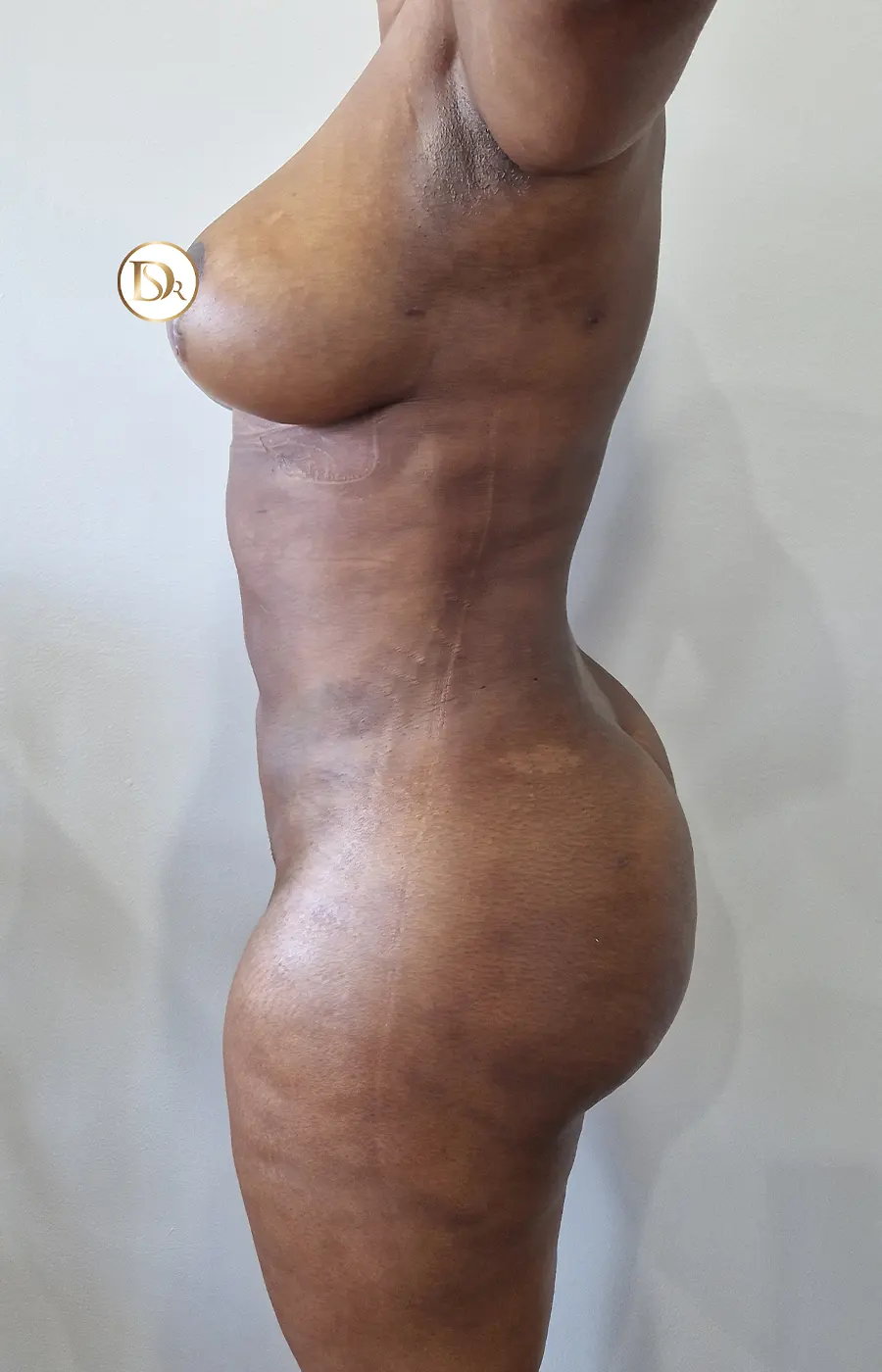 liposuction results after side