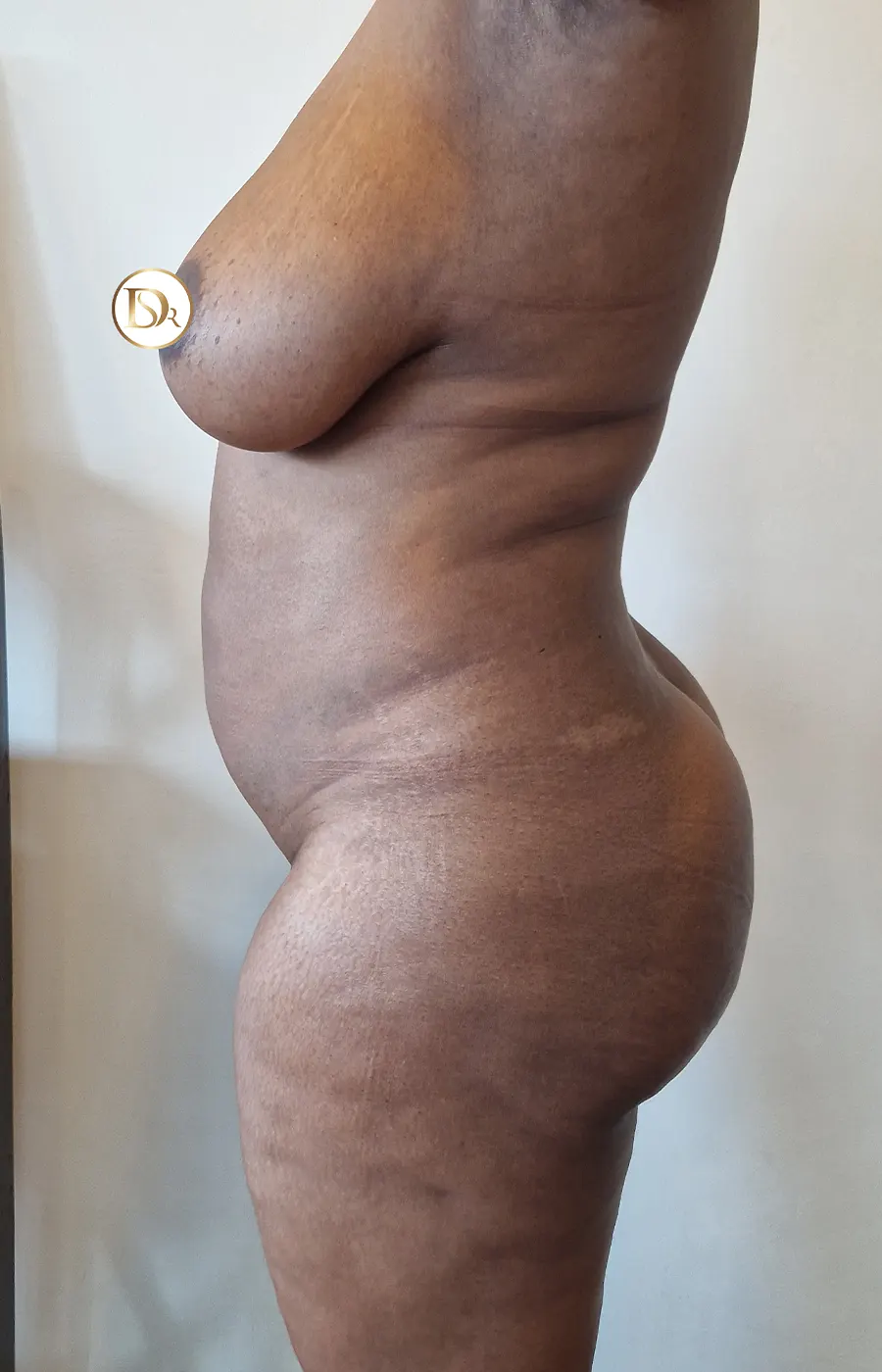 liposuction results before side
