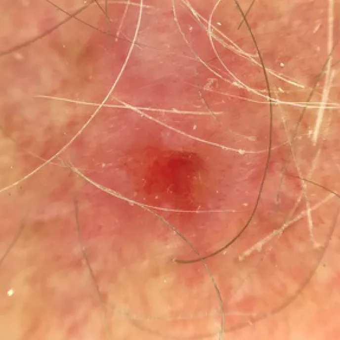 Basal Cell Carcinoma - BCC