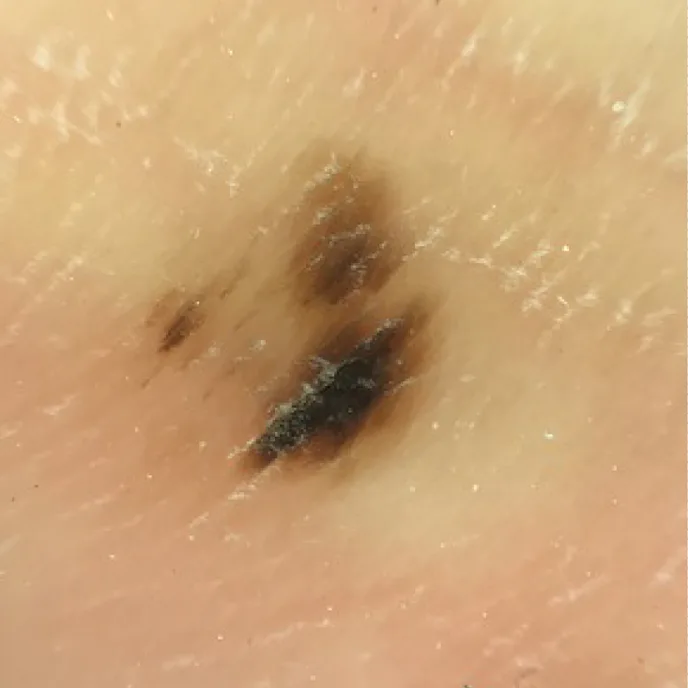 Melanoma In Situ