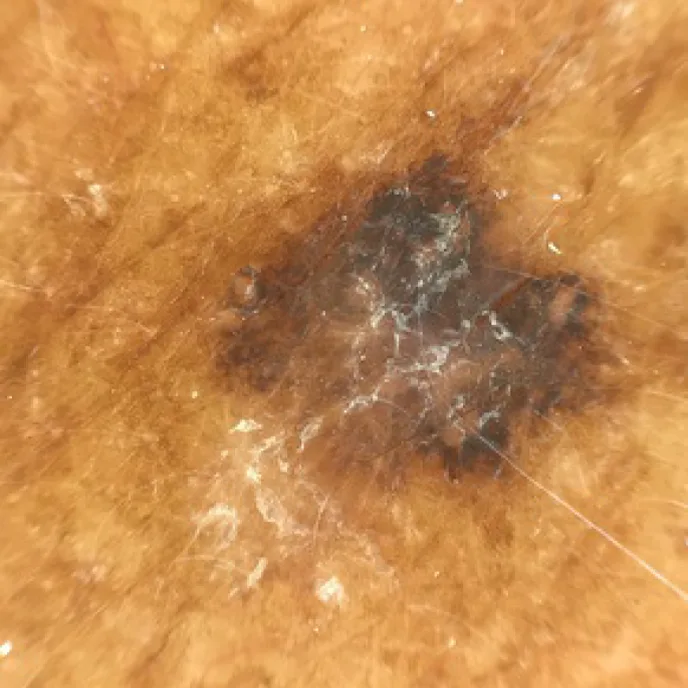 Melanoma In Situ on back