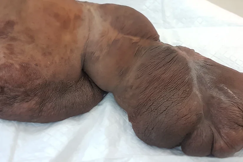 Plexiform Neurofibromatosis-dr-stasch probono
