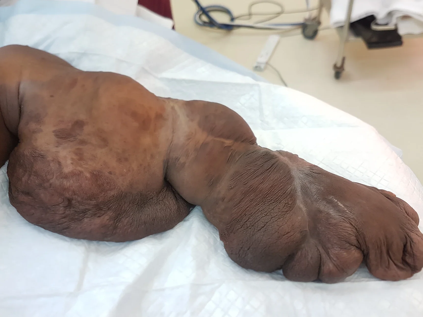 Plexiform Neurofibromatosis dr stasch3 uai