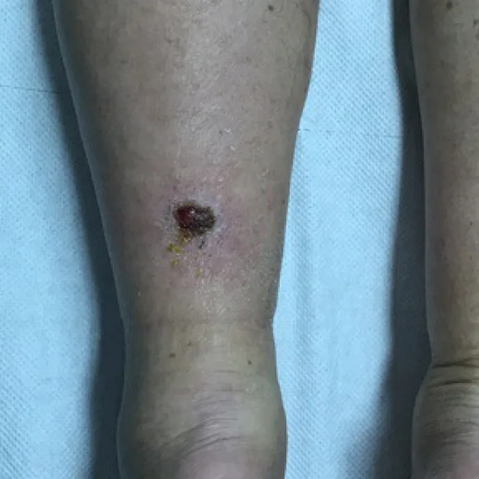 Squamous Cell Carcinoma