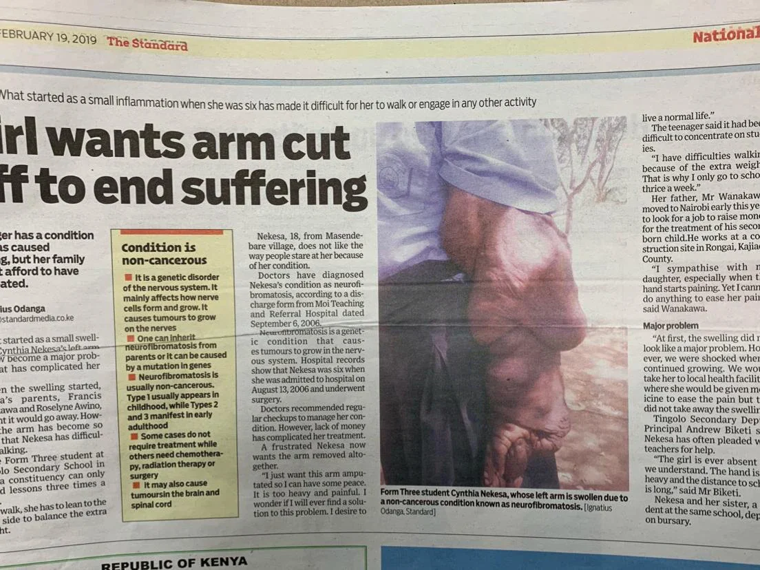 Standard NewsPaper Plexiform Neurofibromatosis 1 uai
