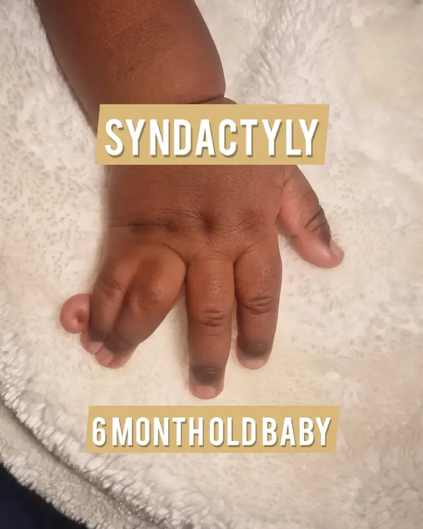 syndactyly surgery in kenya