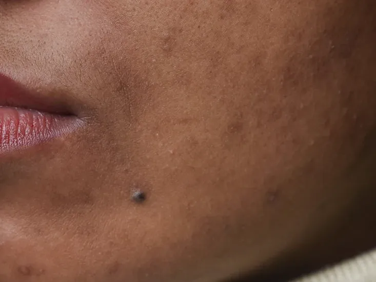 acne treatment uai