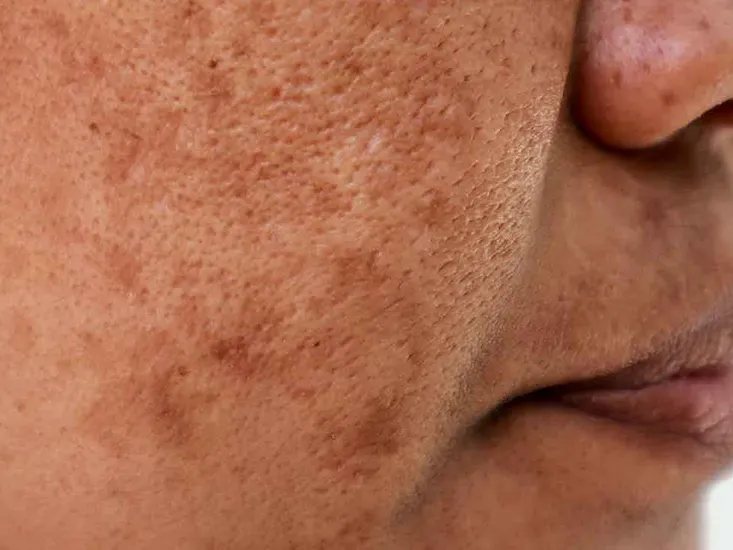 age spots treatment uai