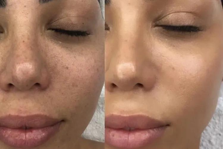 BB Glow Facial 1 bb glow facial uai