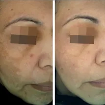 cosmelan-peel-before-and-after 7 cosmelan peel before and after uai