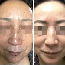 cosmelan-peel-before-and-after2 8 cosmelan peel before and after2 uai