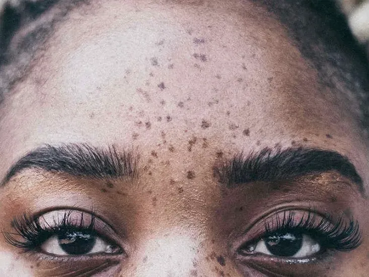 freckles removal treatment uai