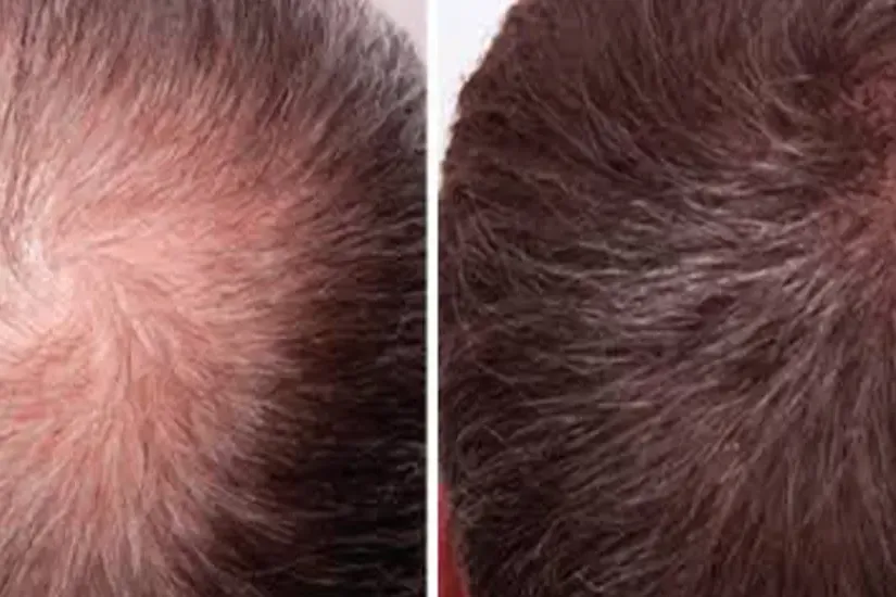 hairline stimulation uai
