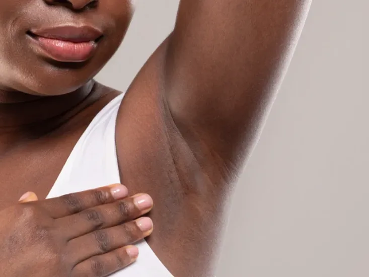 hyperhidrosis excessive sweating uai