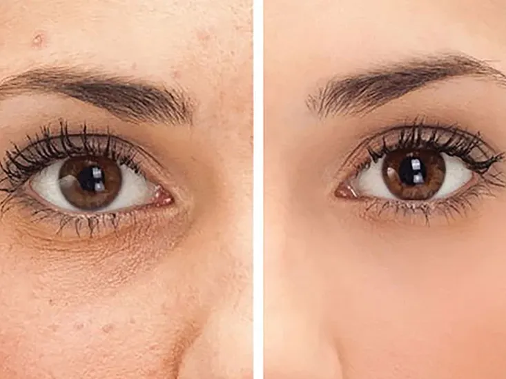 hyperpigmentation reduction uai