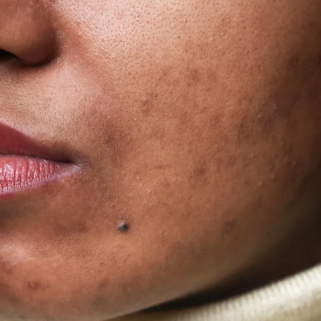 Hyperpigmentation treatment in Nairobi