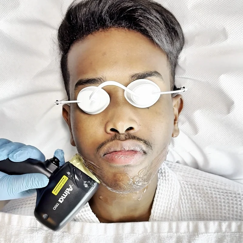 laser hair removal for men in kenya