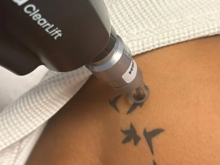 laser tattoo removal uai