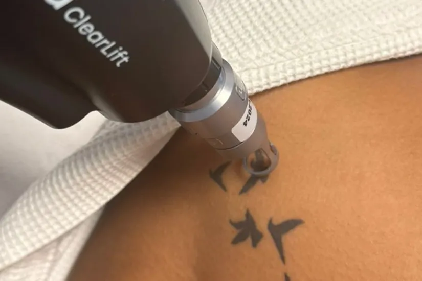 Laser Tattoo Removal 1 laser tattoo removal uai