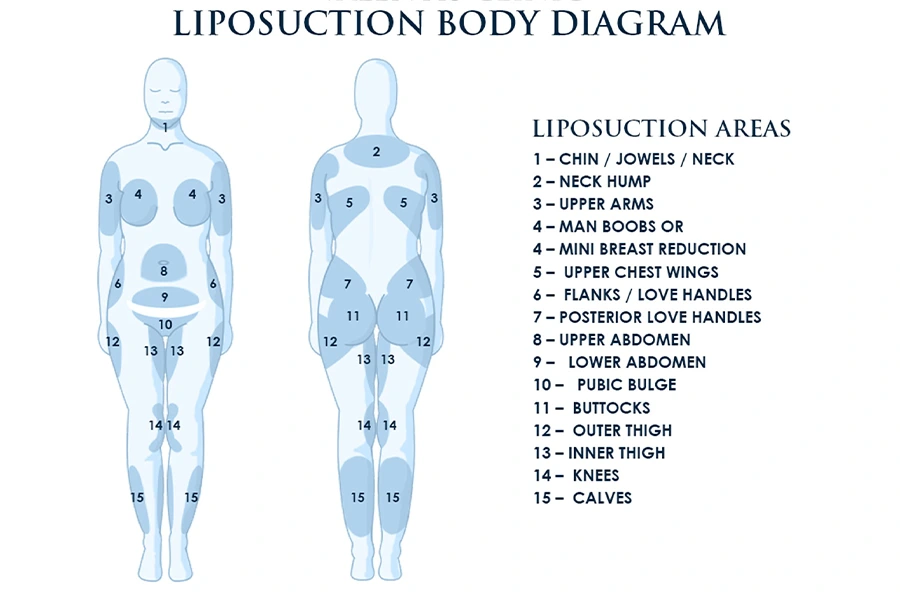 Commonly Treated Areas By Liposuction surgery