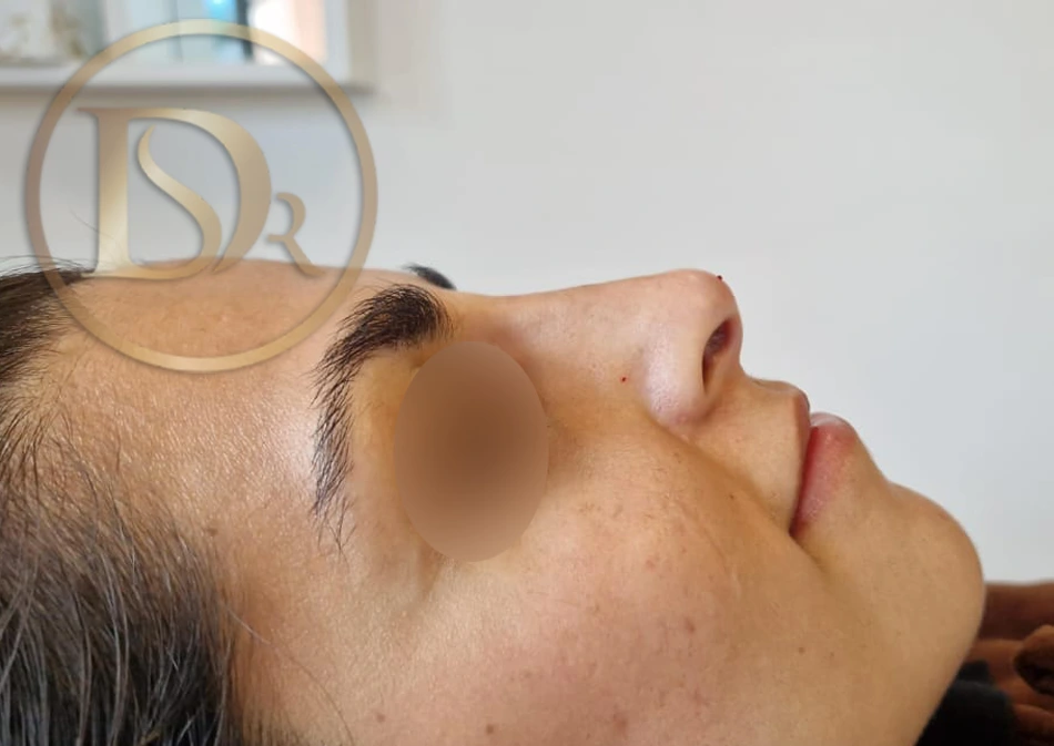 liquid rhinoplasty after picture