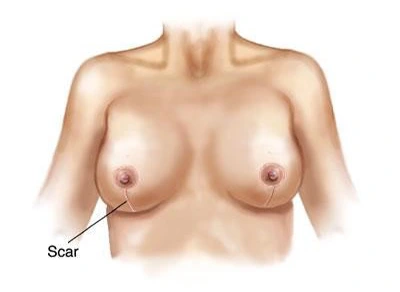 minimal scar breast reduction 2