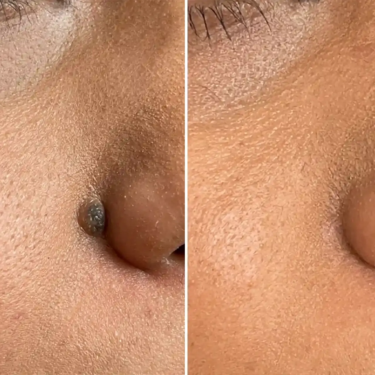 mole removal before and after