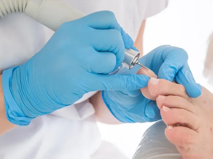 nail fungus removal uai