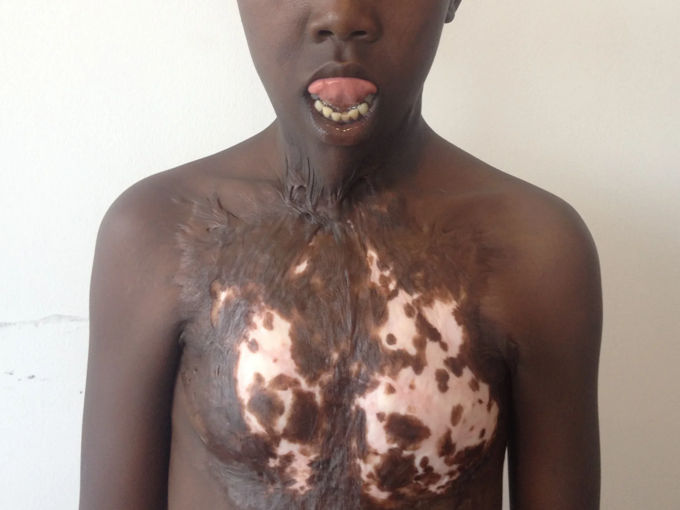 patient with contractures uai