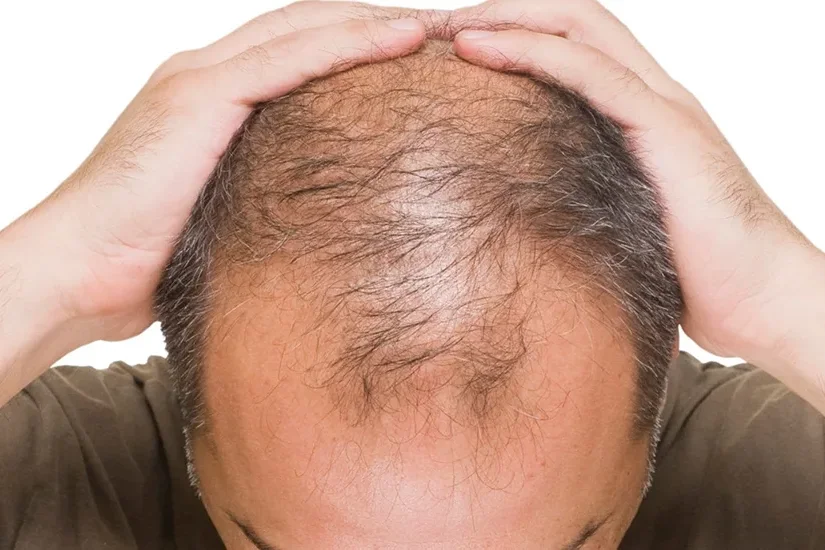 prp for hair loss treatment in kenya