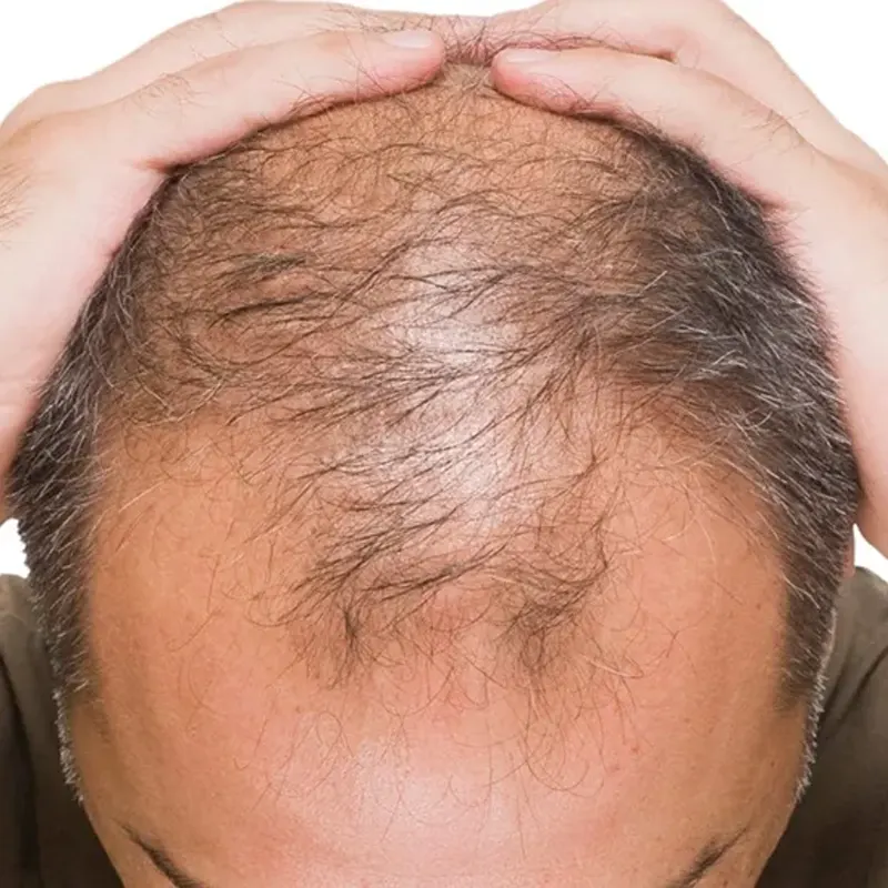 prp for hair restoration