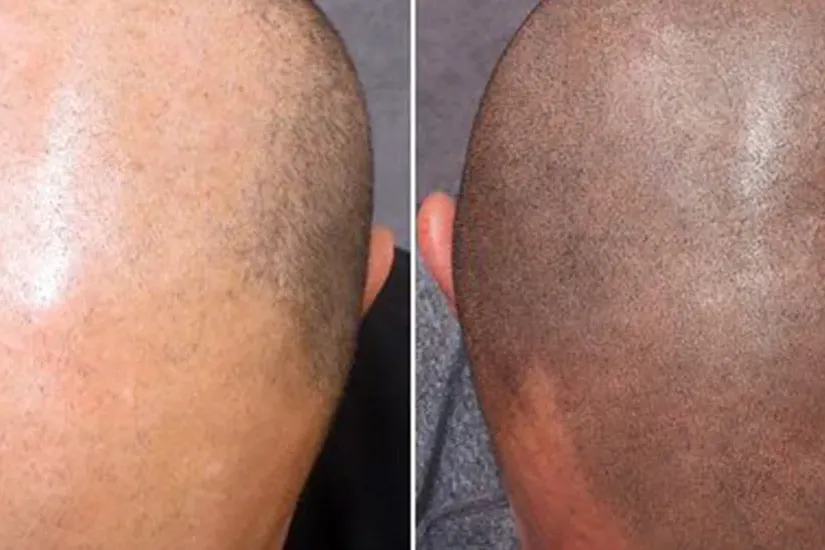 scalp micropigmentation uai