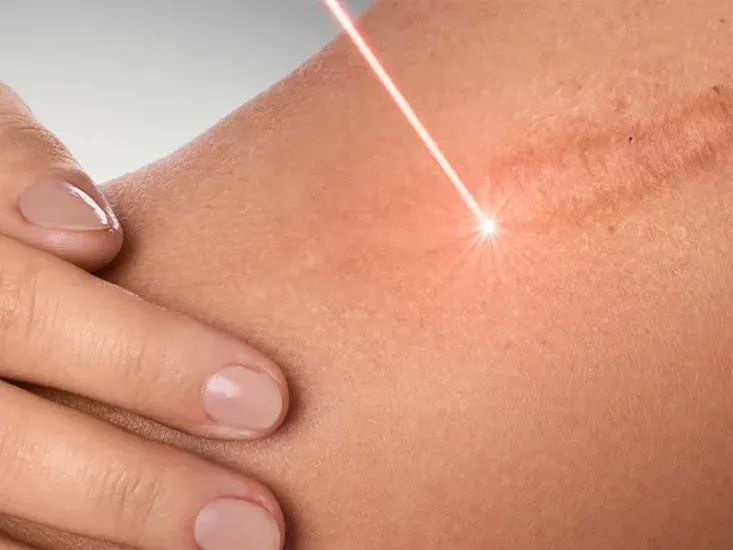 scar removal uai