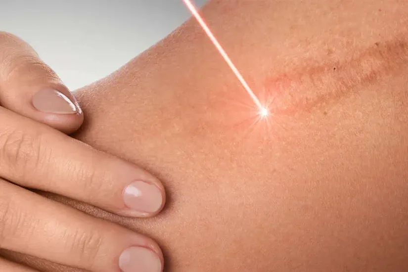 scar removal uai