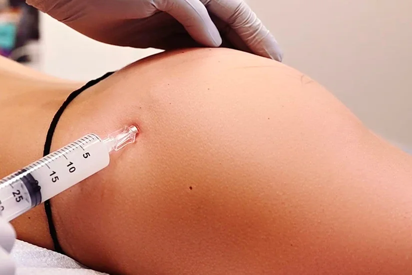 sculptra injections in kenya