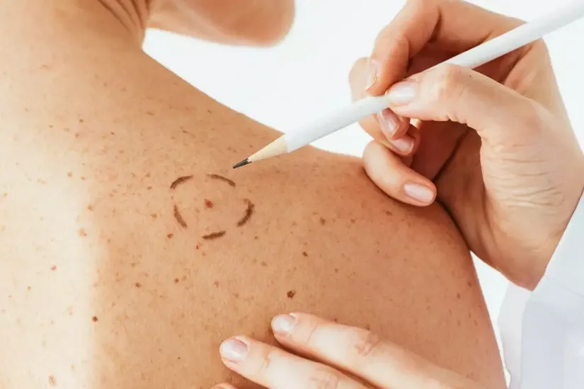 Mole Mapping - Early Detection of Skin Cancer 2 skin cancer mole mapping in nairobi 1 uai