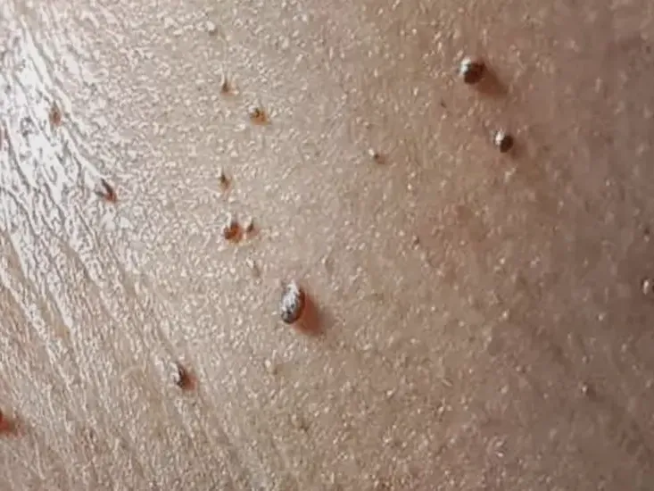 Skin Tags Removal 12 skin tags removal uai