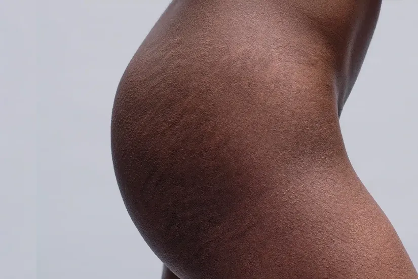 stretch marks treatment uai