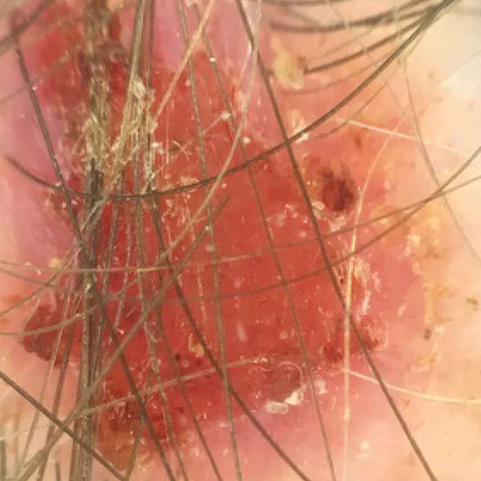 syringocystadenoma-papilliferum-1 24 syringocystadenoma papilliferum 1