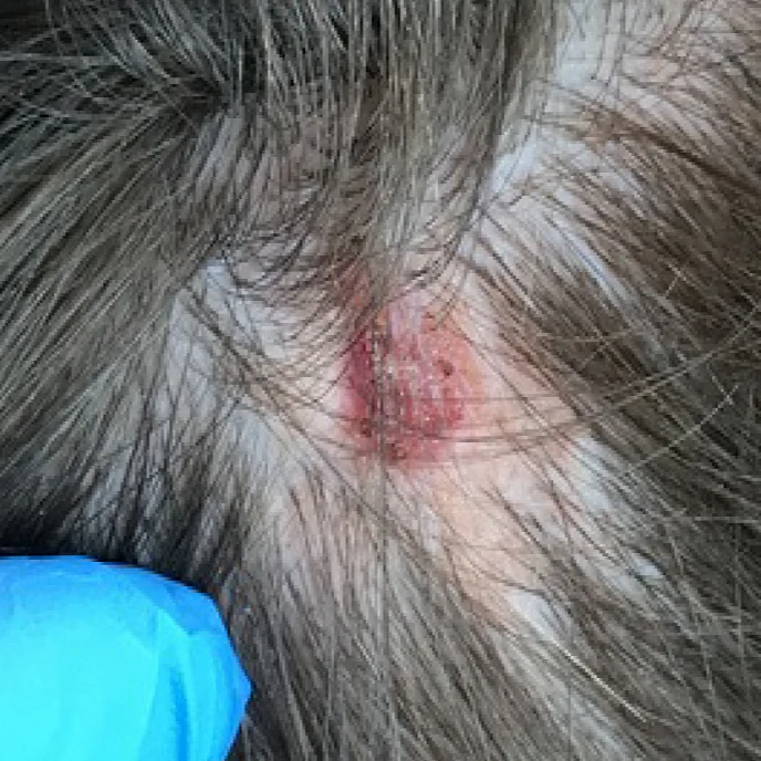 syringocystadenoma-papilliferum-2 25 syringocystadenoma papilliferum 2