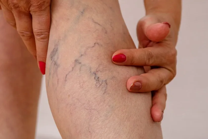 vascular lesions treatment uai